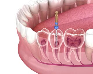 https://focusdentalclinic.ro/wp-content/uploads/2023/08/endo-320x256.jpg