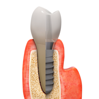 implant dentar https://focusdentalclinic.ro/wp-content/uploads/2023/08/implant-dentar-320x320.png