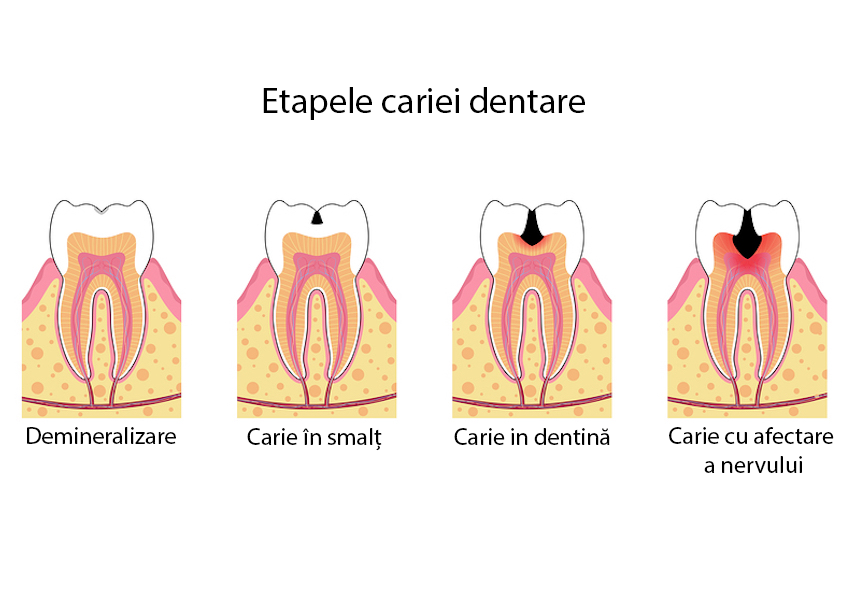 https://focusdentalclinic.ro/wp-content/uploads/2023/09/caria-dentara.png
