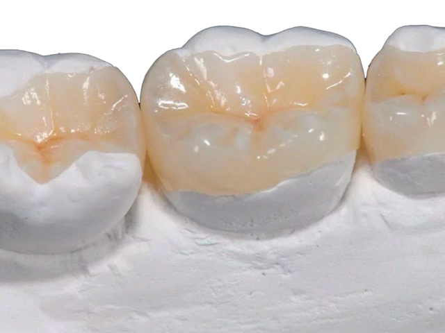 https://focusdentalclinic.ro/wp-content/uploads/2023/09/inlay-640x480.png